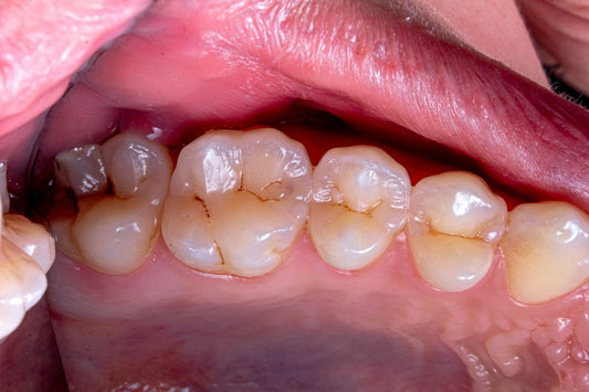 Arrested Caries: What It Means When a Cavity Stops Growing