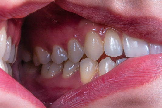 Cavities in 2 Days at Home? What You Can Start Now