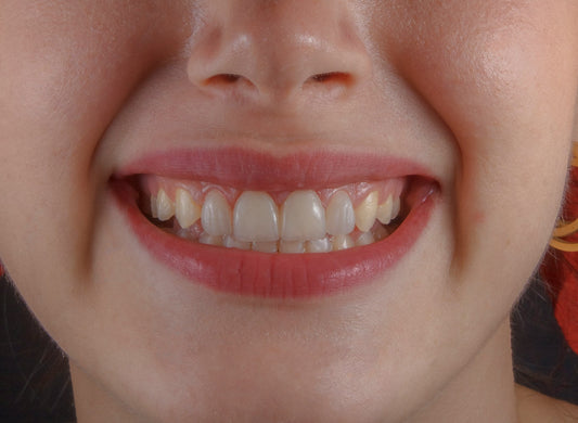 Remineralizing Teeth Naturally: A Daily Routine That Actually Sticks
