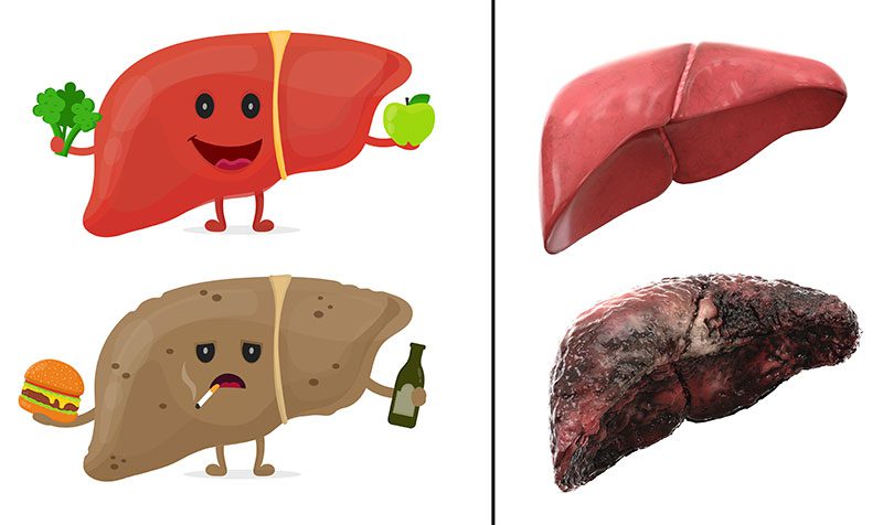 Healthy Liver Foods and Toxic Hepatitis Cirrhosis