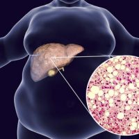 Obesity Steatosis Fatty Liver Disease