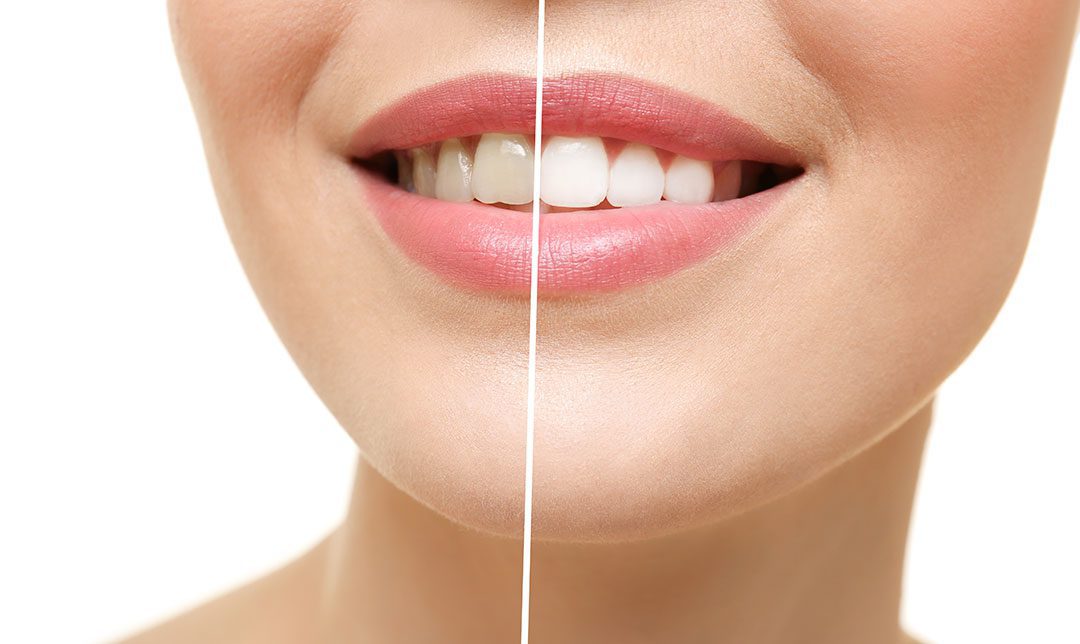 Theobromine Healthy White Teeth Cavity Healing